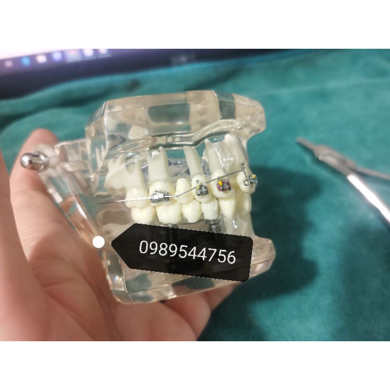 Cung ricketts Bio, cung đánh lún và kéo lui nhóm răng cửa