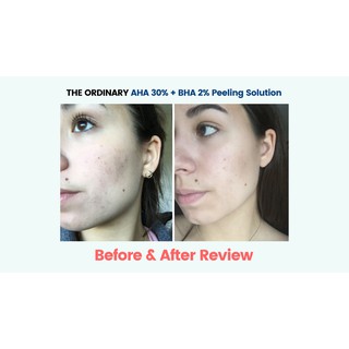 Tinh chất tẩy da chết The Ordinary AHA 30% + BHA 2% Peeling Solution