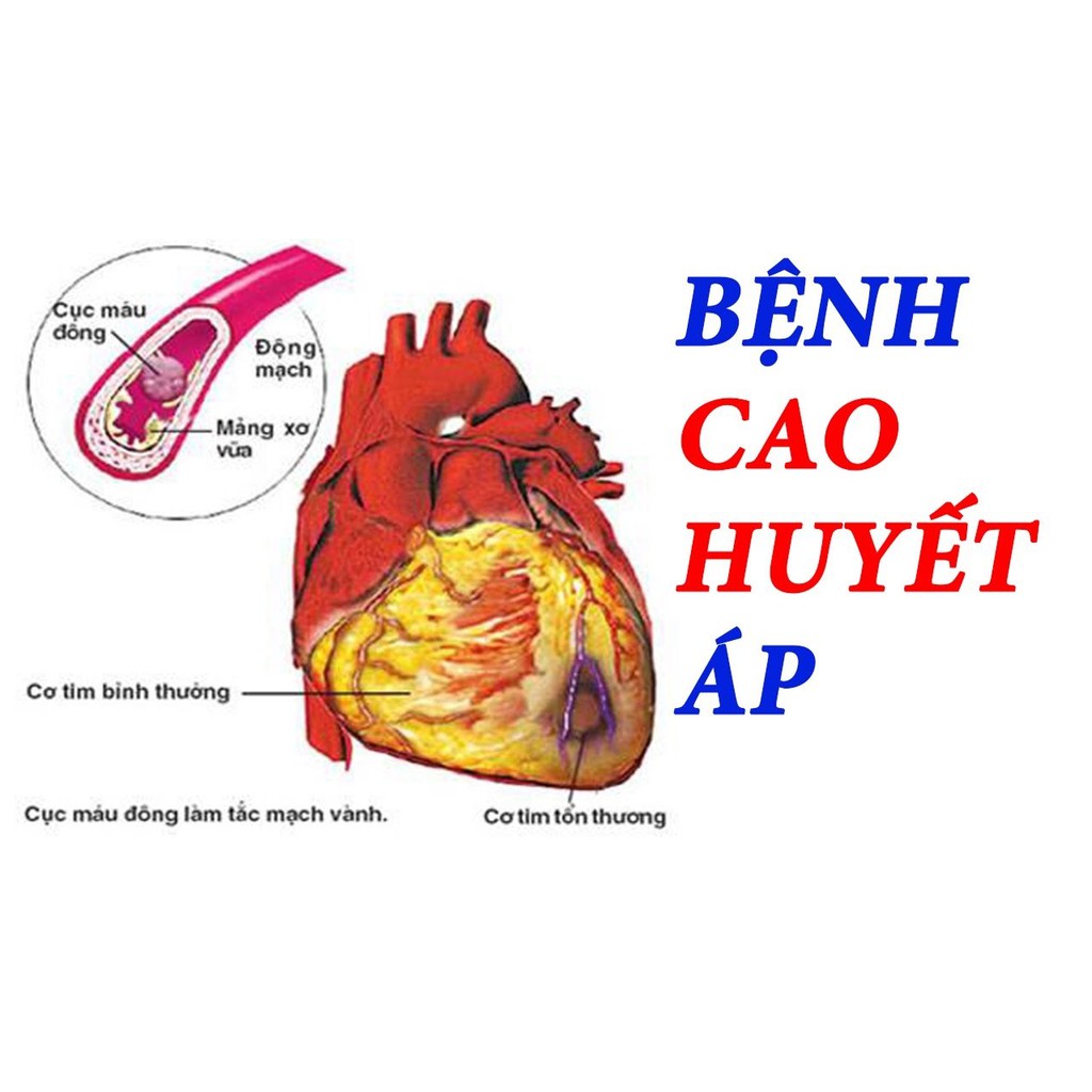 Định Áp Vương - Hỗ trợ làm giảm lipid máu, giãn mạch, dưỡng tâm, hạ cơn tăng huyết áp và dần ổn định huyết áp