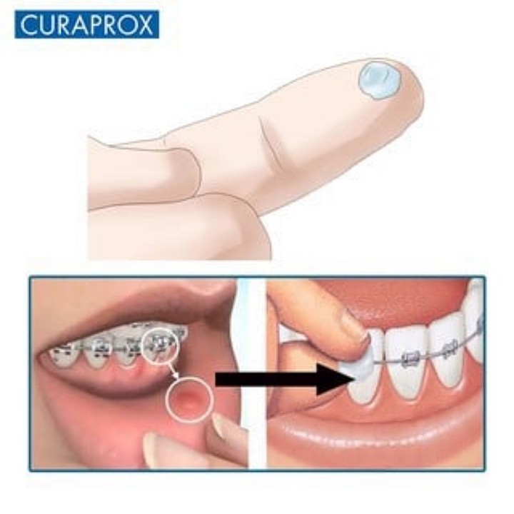 Sáp nha khoa Gum Ortho Wax + Vitamin E cho răng niềng (USA)