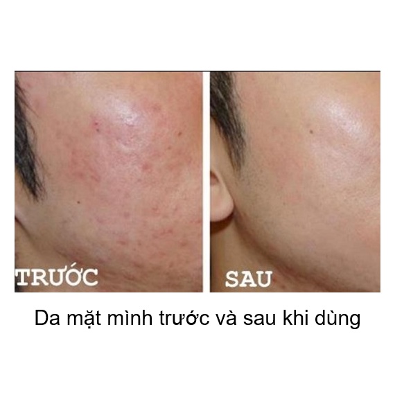 CHẤM MỤN GIẢM SƯNG GOM CỒI - HASI KOKESHI PUREDOLL ACNE SPOT 5ml