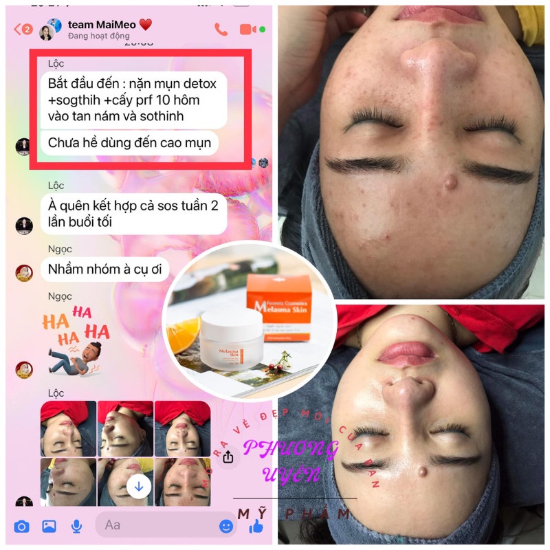 Kem Nám Melasma Skin  🌟 CHÍNH HÃNG🌟 Ngăn Ngừa Nám Và Chống Tăng Sắc Tố Da Sau Laser Hoặc Chấm TCA