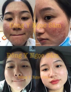 Combo NGỌC SÂM pha sẵn