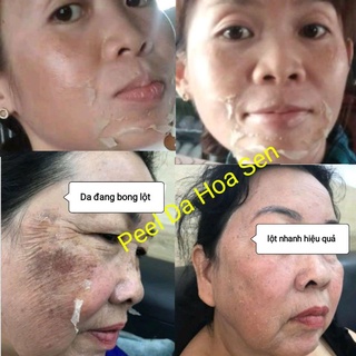 Peel Da Lột Nám Sạm Tàn Nhang Đồi Mồi