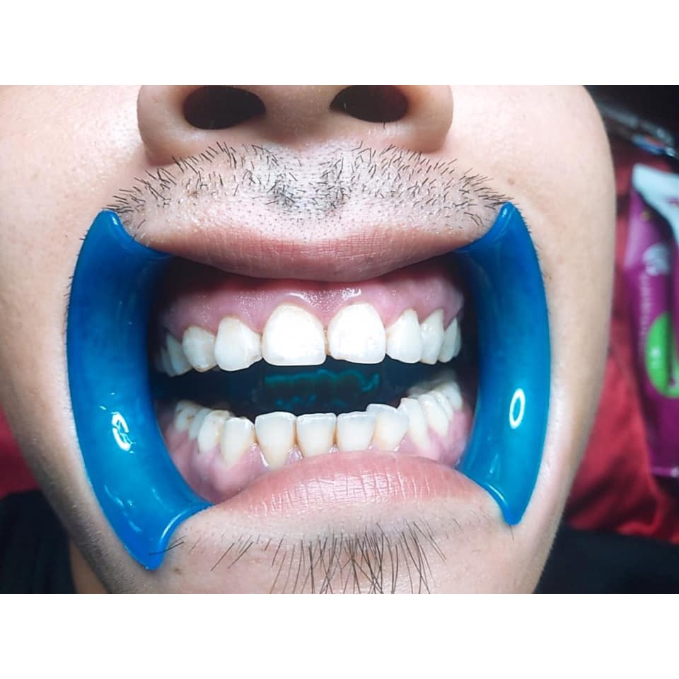 Banh miệng chặn lưỡi nha khoa ,banh miệng tẩy trắng răng,làm răng