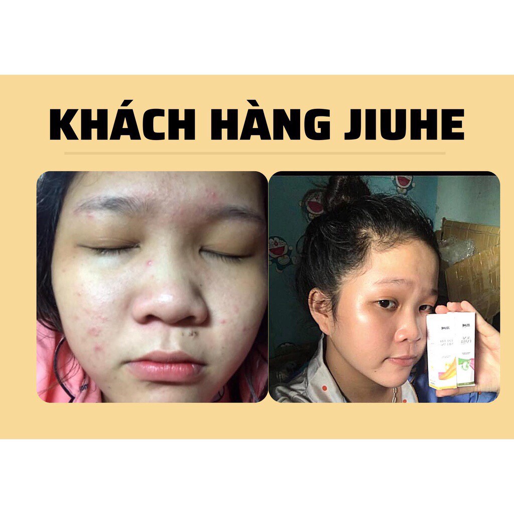 SERUM JIUHE ACNES NANO MỤN THANH TÔ CHÍNH HÃNG 100%