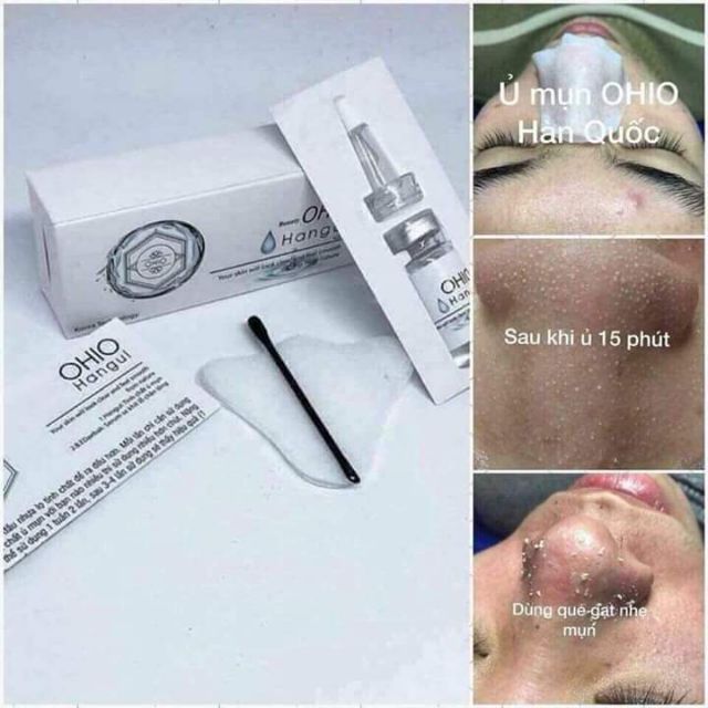 Ủ mụn OHIO - Hàn Quốc