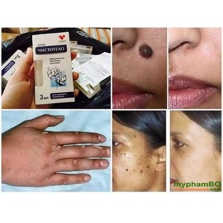 THUỐC TẨY NỐT RUỒI