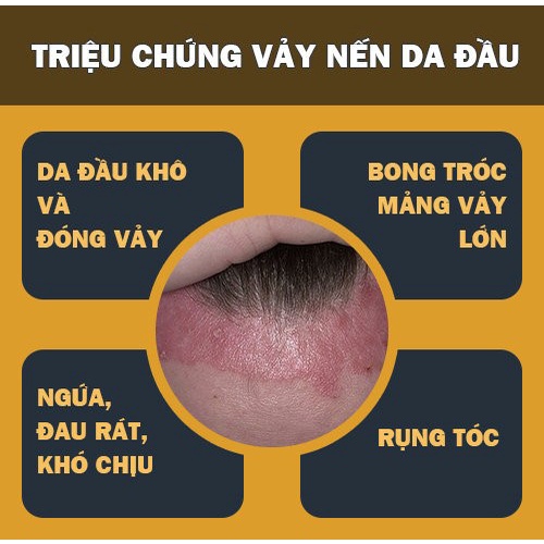 Kem bôi ngoài da Crederm lotion 40ml cùng công thức Beprosalic lotion - Chàm &amp; vẩy nến.