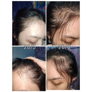 Tinh dầu bưởi vijully kích thích mọc tóc