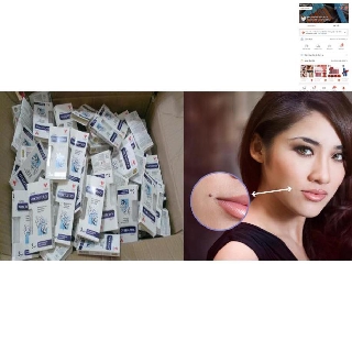 Gel Dvelinil tẩy nốt ruồi, mụn cóc, mụn thịt, sẹo lồi–Nga