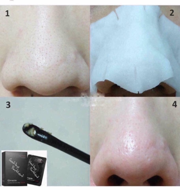 Miếng đẩy mụn đầu đen Blackhead (kèm cây nặn)