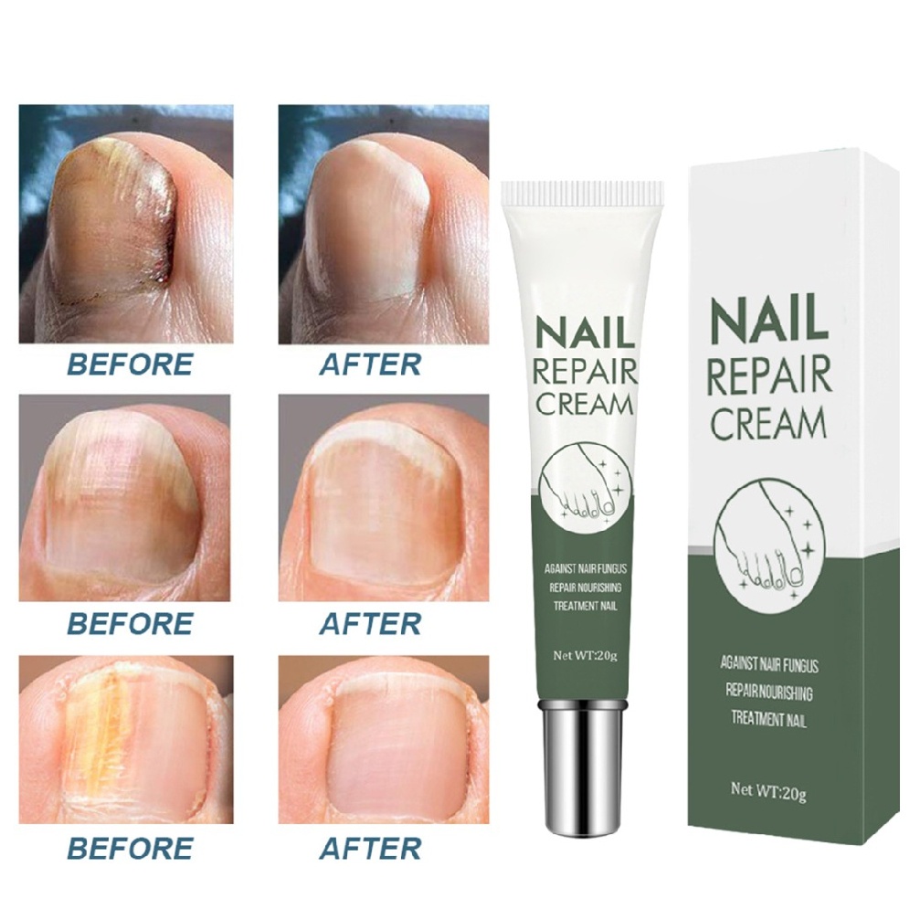 [Hàng mới về] Kem dưỡng phục hồi móng bị hư hỏng mất màu dành cho chăm sóc móng chân 20g