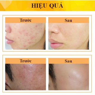 [CHÍNH HÃNG] Giảm Thâm mụn DERMAFORTE
