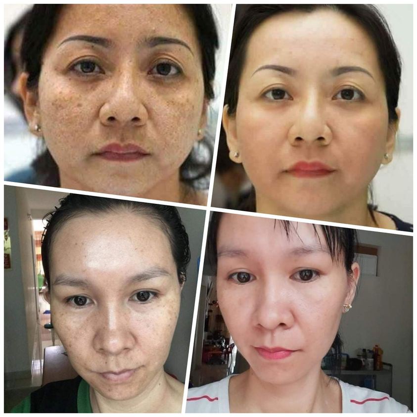 Tinh Chất Nám Linh Hương, Bộ Nám Linh Hương Làm Mờ Vết Nám, Tàn Nhang, Giúp Da Trắng Sáng Hơn Vita White Melasma