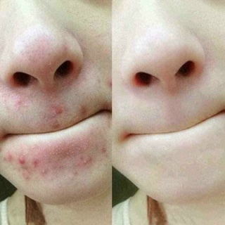 KEM MỤN CENTELLA MEDIPEEL