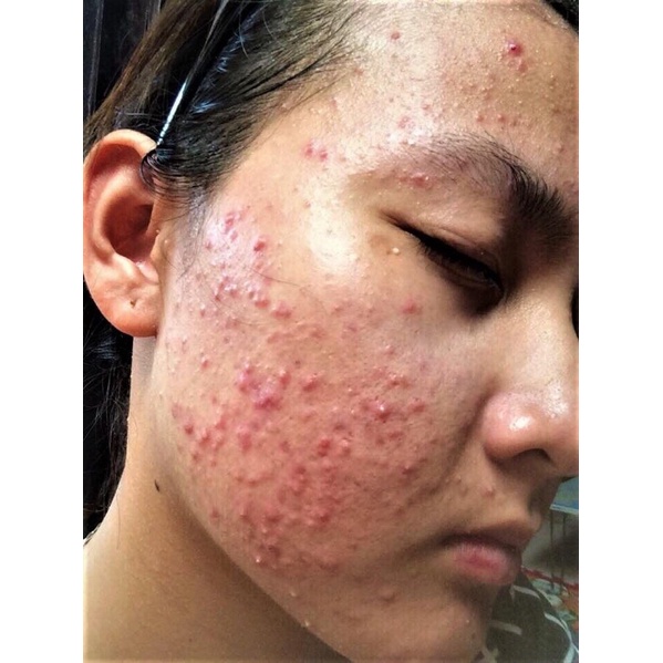 Gel bôi mụn cùng công thức với Differin Adapalene 0.1% dành cho da mụn ẩn mụn mủ viêm mụn đầu đen và da sần sùi | BigBuy360 - bigbuy360.vn