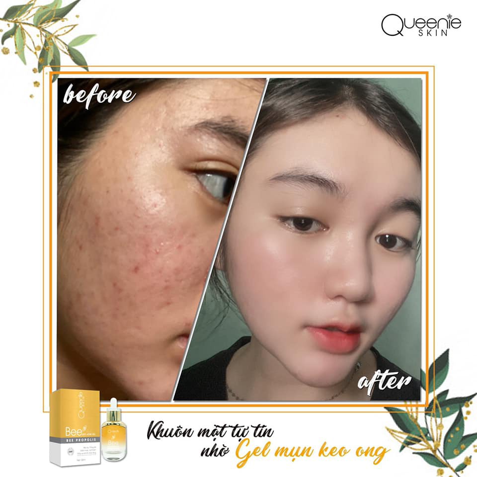 [Rẻ vô địch + Tặng Quà] Gel Mụn Keo Ong Queenie Skin Date Mới Nhất - Gel Mụn Queenie Skin Date 2023