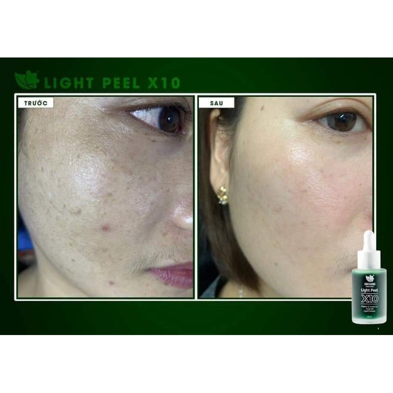 PEEL DA GIẢM NÁM, GIẢM MỤN, TRẺ HÓA DA[CHÍNH HÃNG] | BigBuy360 - bigbuy360.vn