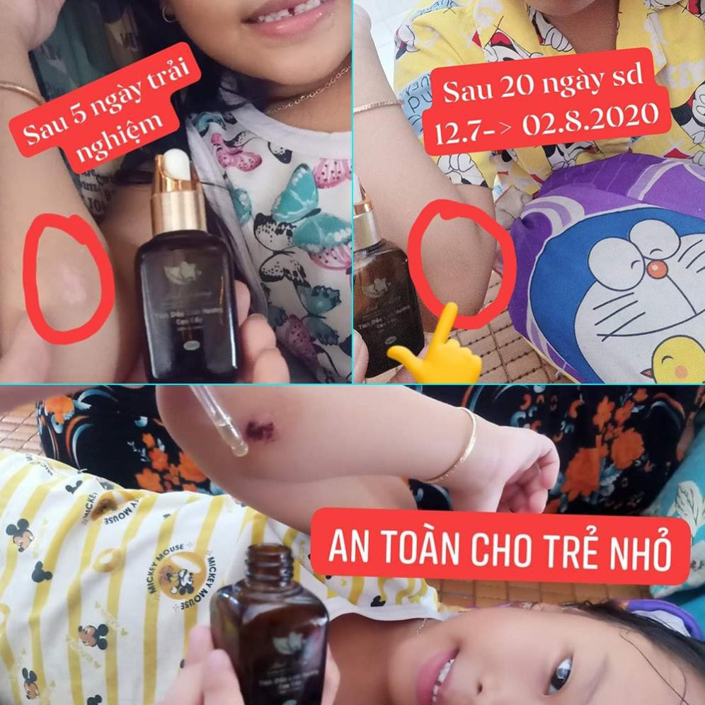 Tinh dầu giảm thâm Linh Hương, làm mờ vết thâm da do sẹo, mụn ở mặt, mờ thâm đầu gối, nách, nhũ hoa, vùng kín