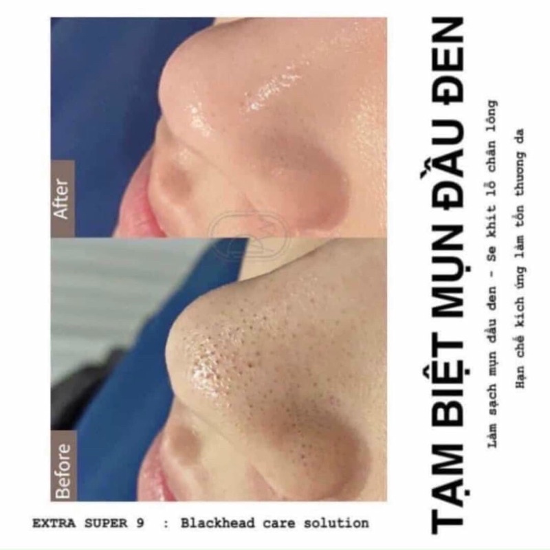 Dung Dịch Ủ Mụn Đầu Đen Spa MEDIPEEL EXTRA SUPER 100ml Chính Hãng | BigBuy360 - bigbuy360.vn