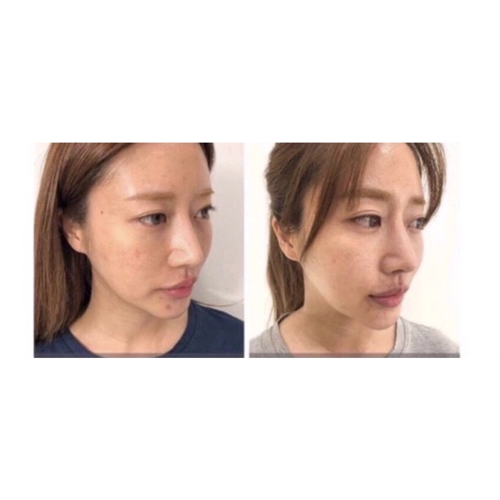 Cao Nám làm giảm làm mờ nám Lumiderm