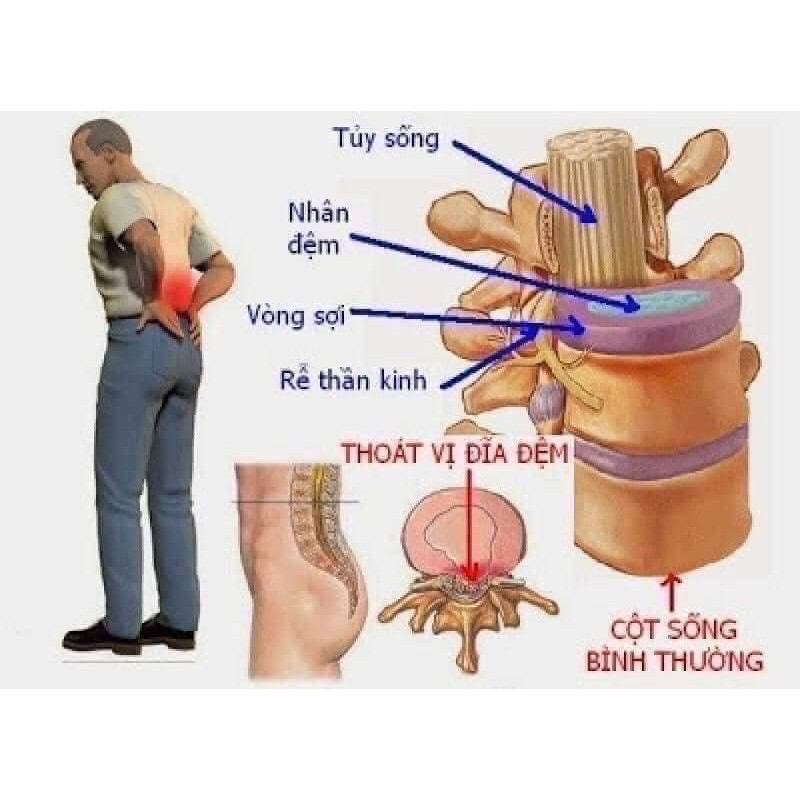 🦴 Gel Thoa Thoát Vị Đĩa Đệm Difelene 1% Thái Lan 🇹🇭