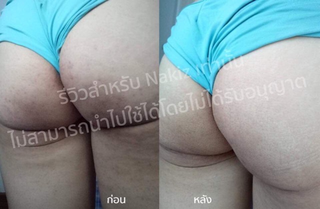COMBO 2 NAKIZ LIVELY BUTT【CHÍNH HÃNG】 Kem giảm thâm, mụn Mông, Bẹn, Nách, Lưng, Nhũ hoa, Cùi chỏ, Đầu gối .... Thái Lan | BigBuy360 - bigbuy360.vn