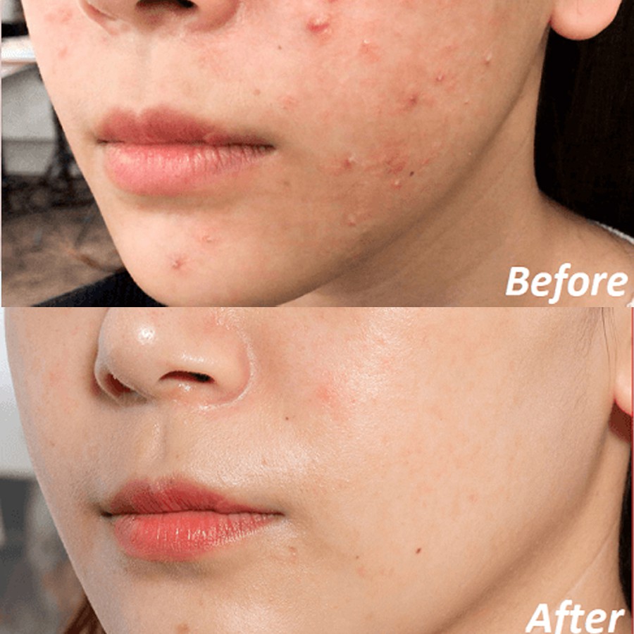 Kem Hỗ Trợ Giảm Mụn Chuyên Biệt La Roche Posay Effaclar A.I. Targeted Imperfection Corrector