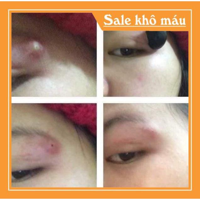 5 hạt đậu lào hút độc - Dược Liệu Sạch