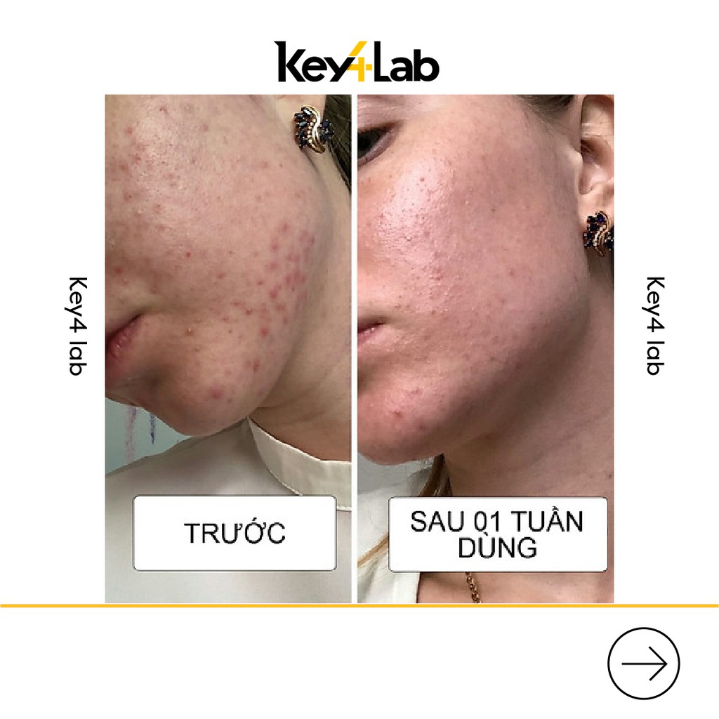 Kem hỗ trợ loại bỏ và ngăn ngừa mụn viêm anti-acne sos 24h Propeller 50ml Key4 Lab | BigBuy360 - bigbuy360.vn