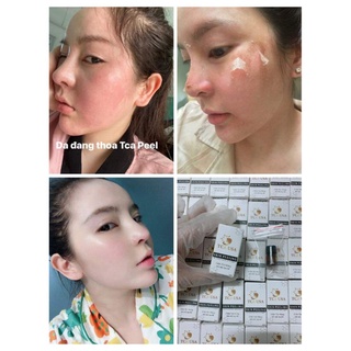 SÉT TCA CHẤM PEEL NÁM TÀN NHANG 35%