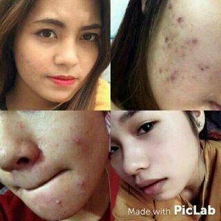 Kem bôi Shiseido Pimplit Nhật Bản 15g