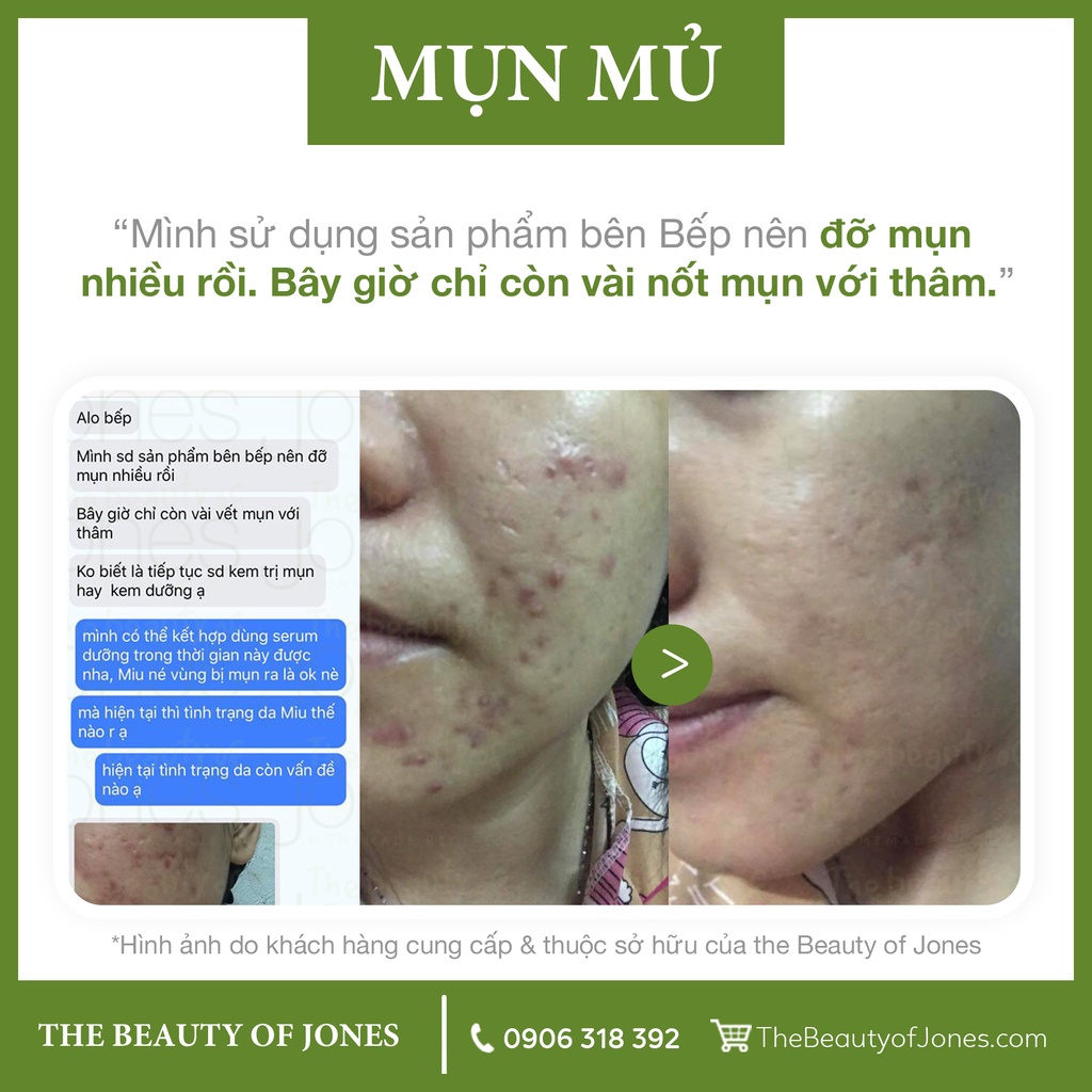 Combo làm sạch và ngừa mụn The Beauty of Jones