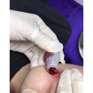 Ống hút mụn hút máu bầm