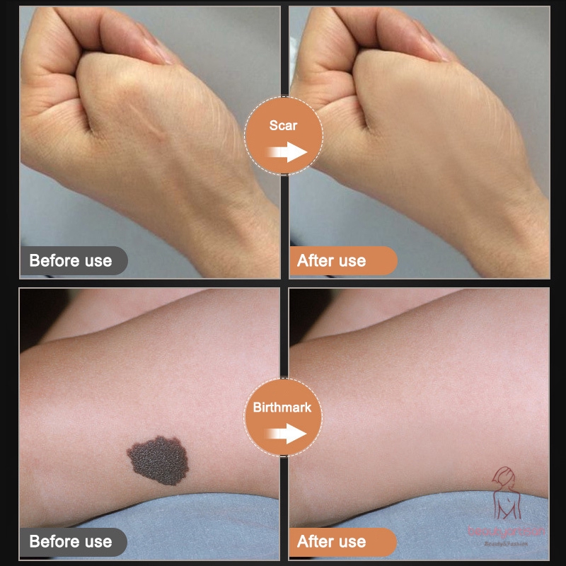 [Hàng mới về] Kem che vết xăm/sẹo 2 tông màu chống nước | BigBuy360 - bigbuy360.vn