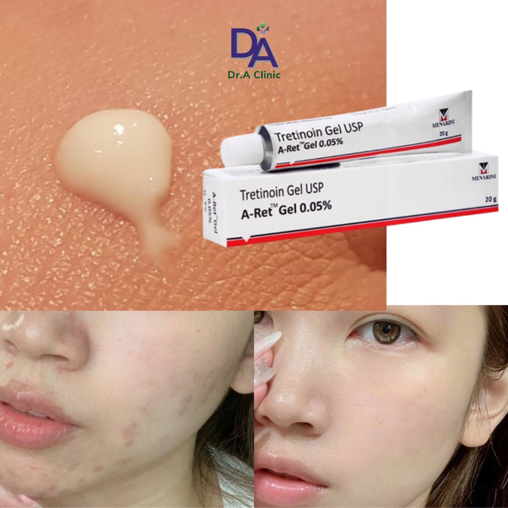Tretinoin Aret Ấn Độ 0.025 0.05 0.1 Chính Hãng Dr.A Clinic dưỡng da căng bóng, tái tạo trẻ hoá da