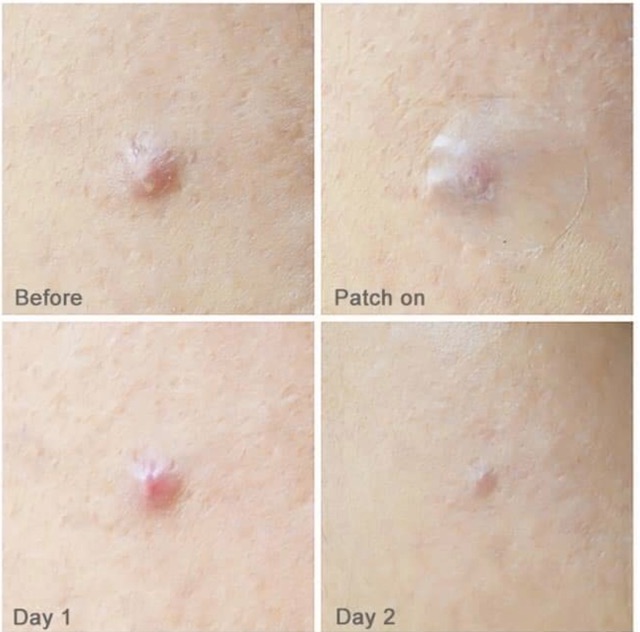 Miếng Dán Mụn Olive Young Careplus