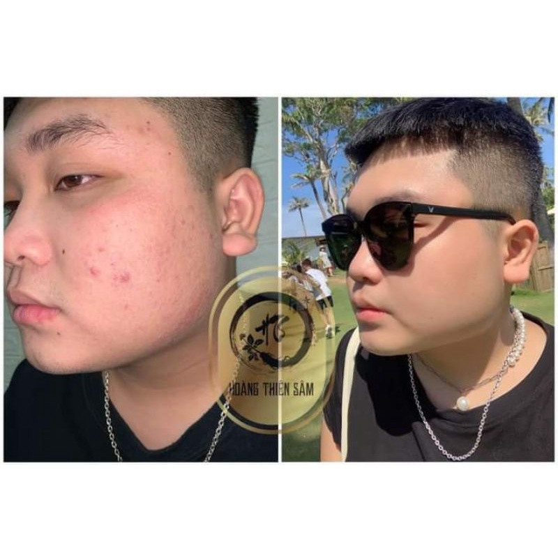 Serum Giảm Mụn Thâm Rỗ - Tinh Chất Hoàng Thiên Sâm 30ml Tái Tạo Da  - Dành Cho Da Chai Lì Khó Hấp