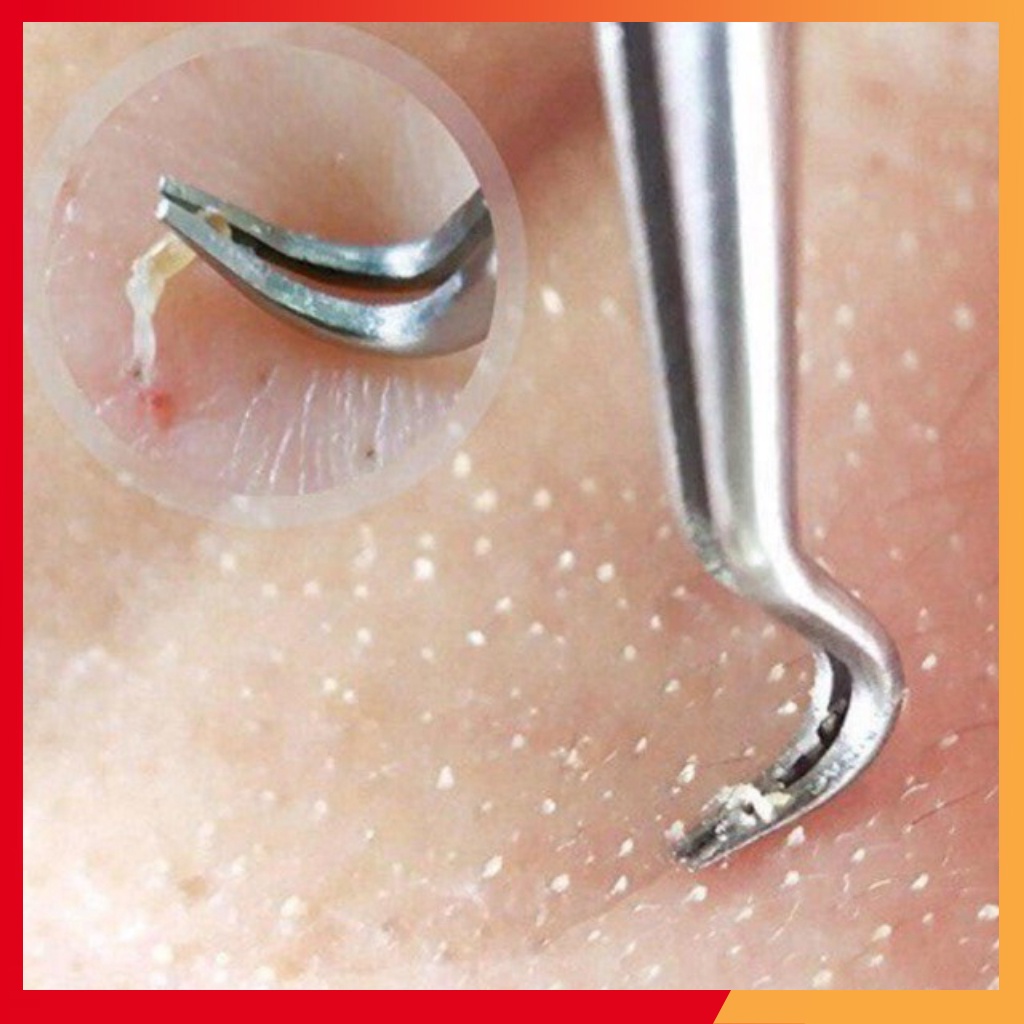 NHÍP GẮP MỤN THẦN THÁNH