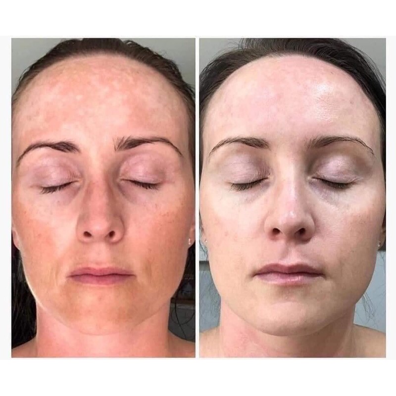 Serum thần thánh Neoretin discrom control booster fuild phục hồi làn da - Chính hãng