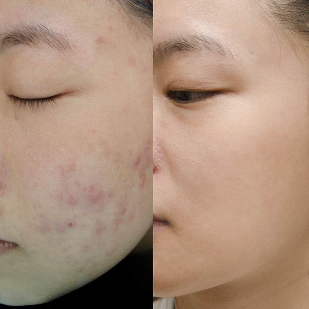 Bộ đôi Toner Tràm Trà, Siêu Tinh Chất Tràm Trà giảm mụn sau 14 ngày Derladie Herbal For Blemish