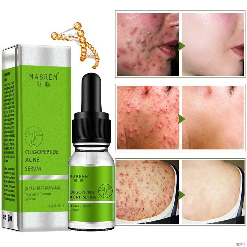 [Hàng mới về] Tinh Chất Oligopeptide Giảm Mụn Dưỡng Ẩm Làm Mịn Da Hiệu Quả