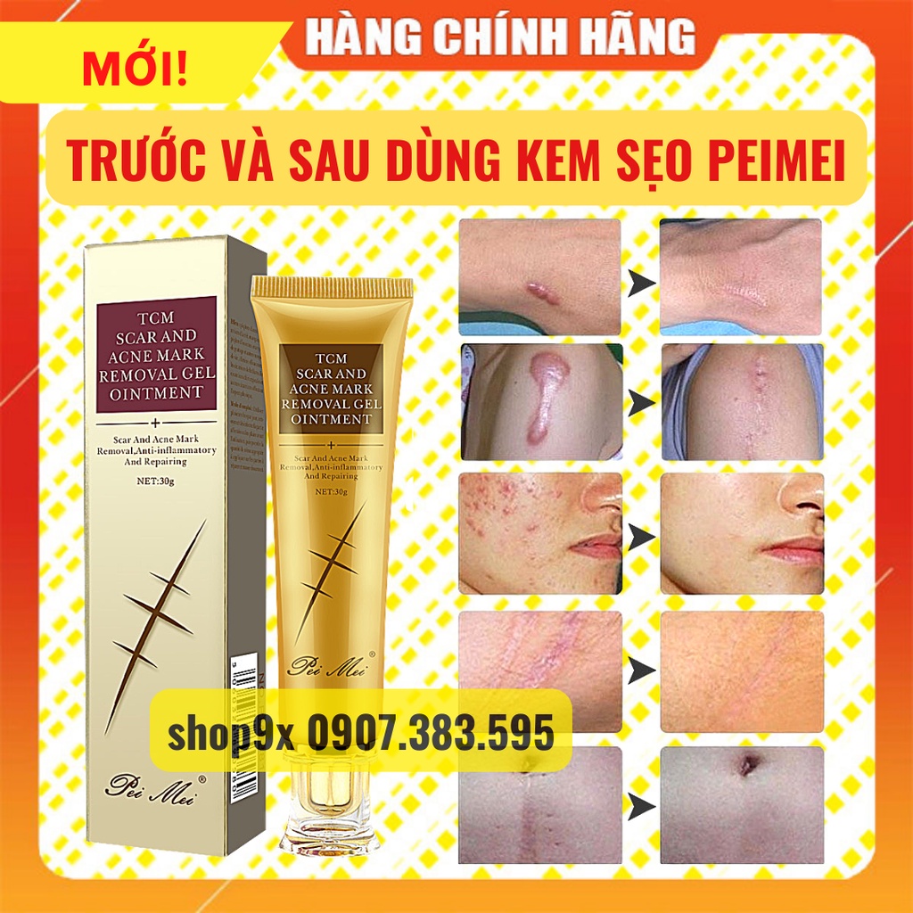 Kem Sẹo Peimei - Giảm Sẹo Và Rạn Da Hiệu Quả Sau 1 Tuần 30gr