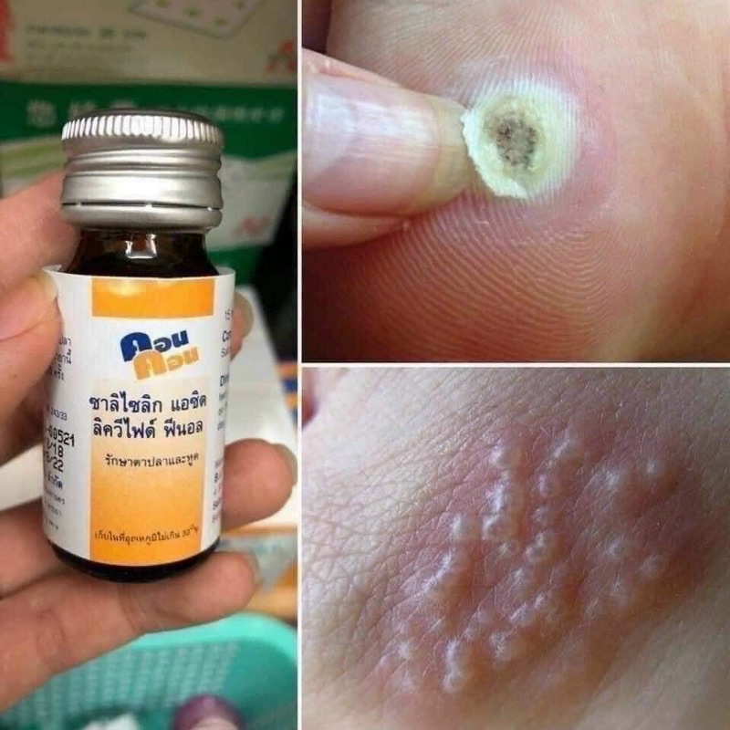 Chấm mụn cơm ,mụn cóc ConCon Thái Lan