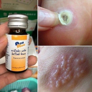 Chấm mụn cơm ,mụn cóc ConCon Thái Lan