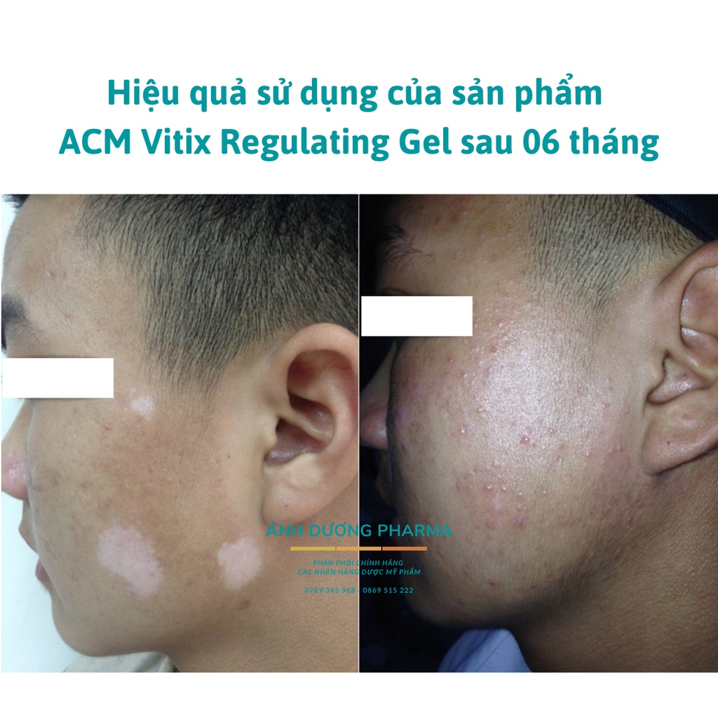 Gel ngăn ngừa bạch biến ACM Vitix Regulating Gel - Mini size 5ml