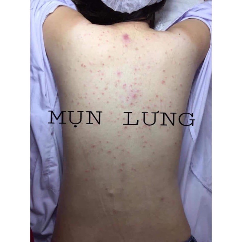 MEN VI SINH TAVIDA HẾT MỤN LƯNG VIÊM NANG LÔNg MẨN NGỨA | BigBuy360 - bigbuy360.vn