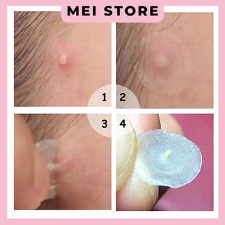 Miếng dán mụn BREYLEE cao cấp