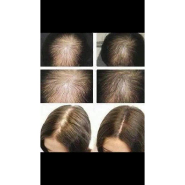 TINH CHẤT KÍCH THÍCH MỌC TÓC CHOOSEI 30ML bao check bill